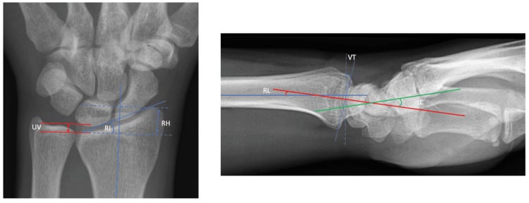 PA and lateral wrist radiographs labelled with ulnar variance, radial inclination, radial height, volar tilt and carpal angles