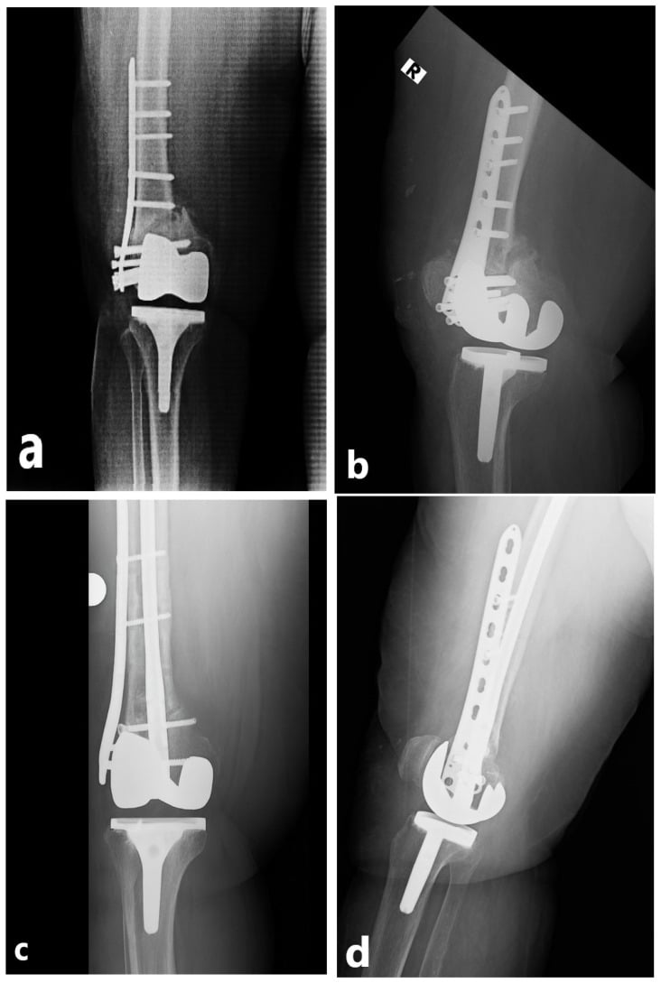 Radiographs showing failed lateral plate fixation of a periprosthetic distal-femoral fracture and revision with a combined nail-plate construct.