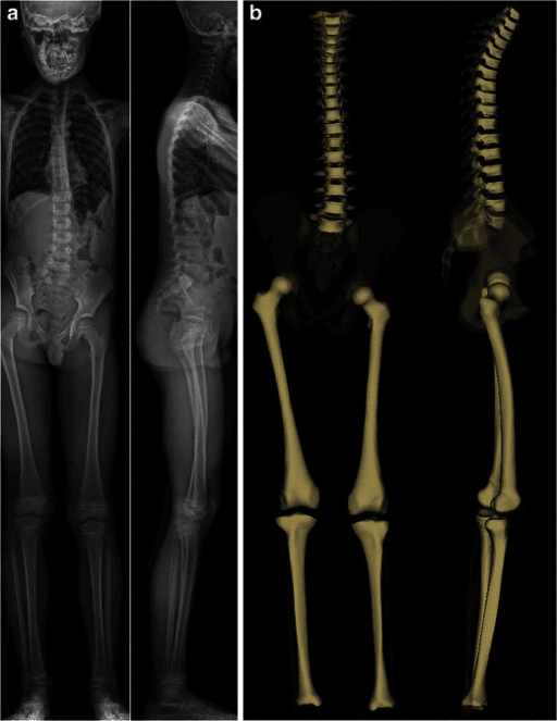 Pediatric scoliosis plain radiograph and 3D reconstruction
