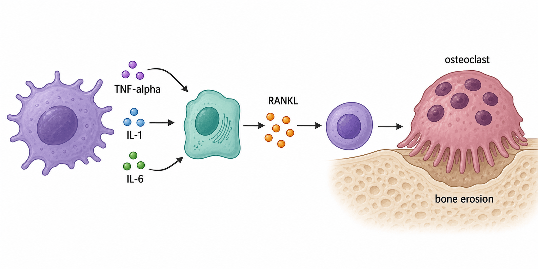 Schematic showing TNF-alpha, IL-1 and IL-6 from an immune cell driving stromal RANKL, an osteoclast and bone erosion