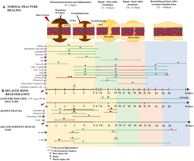 Normal and delayed fracture-healing immune-cell timeline