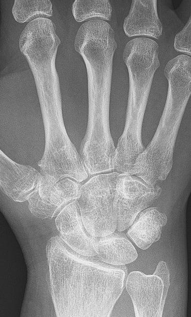 PA radiograph of the hand in rheumatoid arthritis showing metacarpophalangeal joint changes