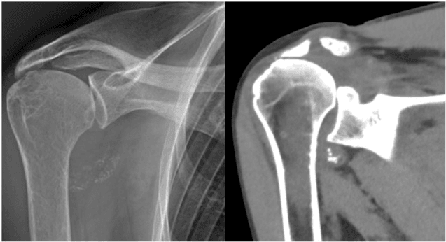 Shoulder radiograph and CT showing calcifications in the axillary recess