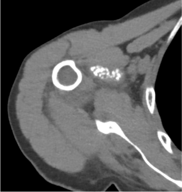 Shoulder CT showing a cluster of calcific deposits within the supraspinatus muscle