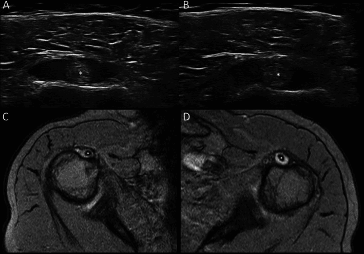 Polymyalgia rheumatica: shoulder ultrasound (A, B) and MRI (C, D) of both shoulders