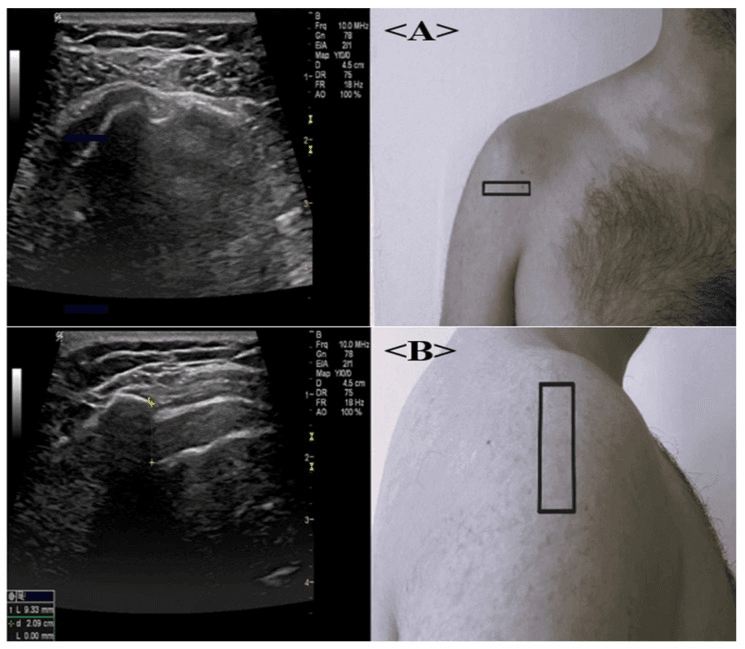 Rheumatoid shoulder ultrasound of the biceps tendon (A) and acromiohumeral distance measurement (B), each beside a photograph marking the probe position