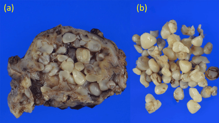 Gross shoulder bursa specimen opened to show numerous rice bodies (a) and the extracted rice bodies (b)