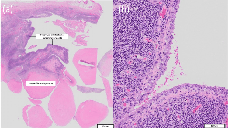Histology of fibrin rice bodies and inflamed shoulder synovium: (a) labelled dense fibrin deposition and synovium infiltrated by inflammatory cells, scale bar 2 mm; (b) inflamed synovium, scale bar 100 micrometres