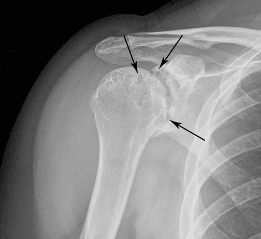 AP shoulder radiograph in rheumatoid arthritis from a reported rice-body arthropathy case
