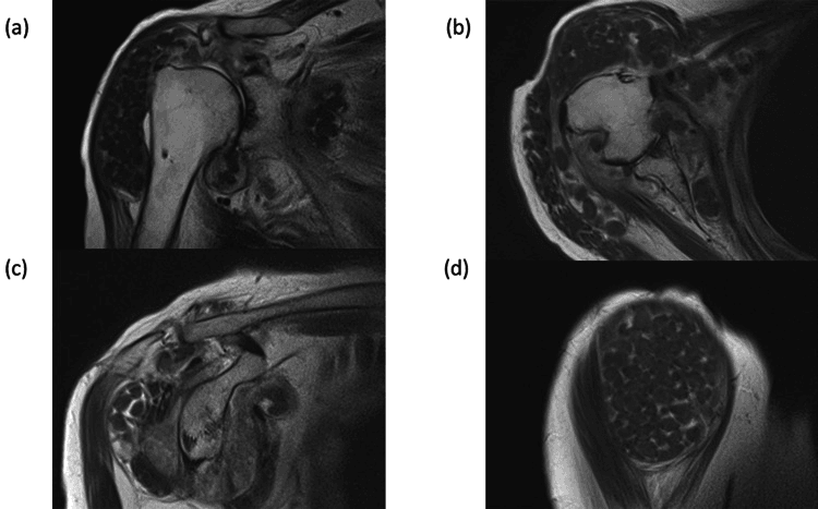 Shoulder MRI (a-d) showing numerous subacromial rice bodies and massive rotator cuff tear