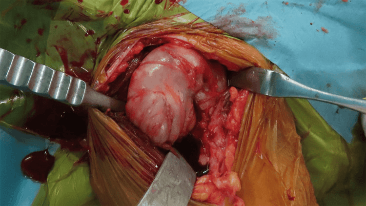 Operative shoulder view showing a distended bursa, containing rice bodies, exposed between retractors