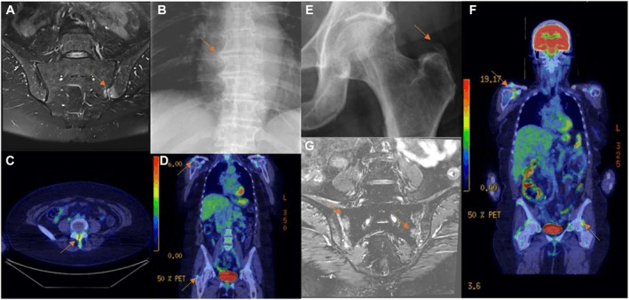 Multipanel MRI, radiograph and PET-CT examples (A-G) distinguishing polymyalgia from late-onset spondyloarthritis, arrows marking the findings