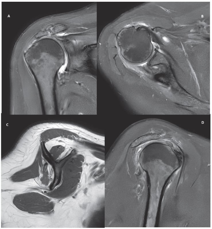 Coronal, axial and sagittal MRI of an irreparable posterosuperior tear with advanced fatty infiltration