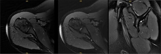 Three-panel shoulder MRI showing isolated infraspinatus atrophy with a preserved supraspinatus belly
