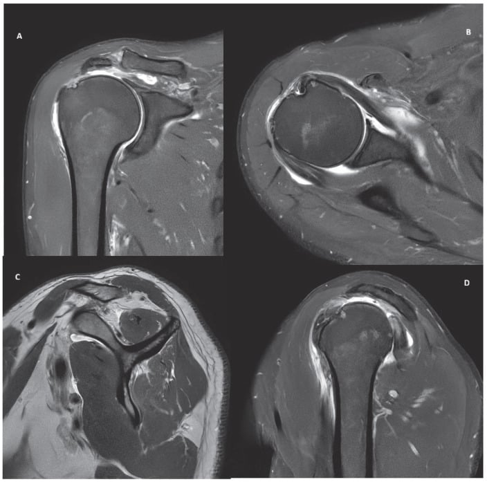 Coronal, axial and sagittal MRI of a posterosuperior massive cuff tear involving supraspinatus and infraspinatus