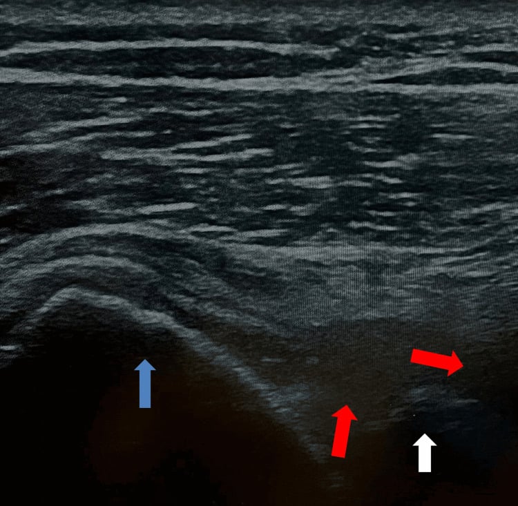 Shoulder ultrasound showing a paralabral cyst projecting into the spinoglenoid notch beside the humeral head