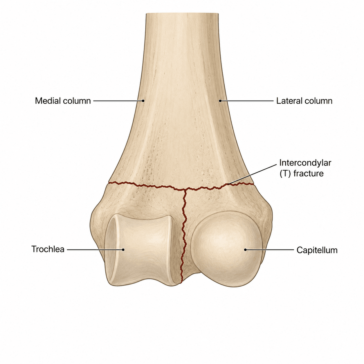 Labelled AP diagram of the distal humerus showing the medial and lateral columns, trochlea and capitellum, and an intercondylar T-shaped fracture.