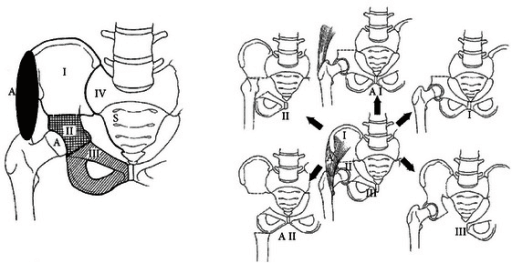 Schematic diagram of the pelvis showing zones used to classify pelvic resections.