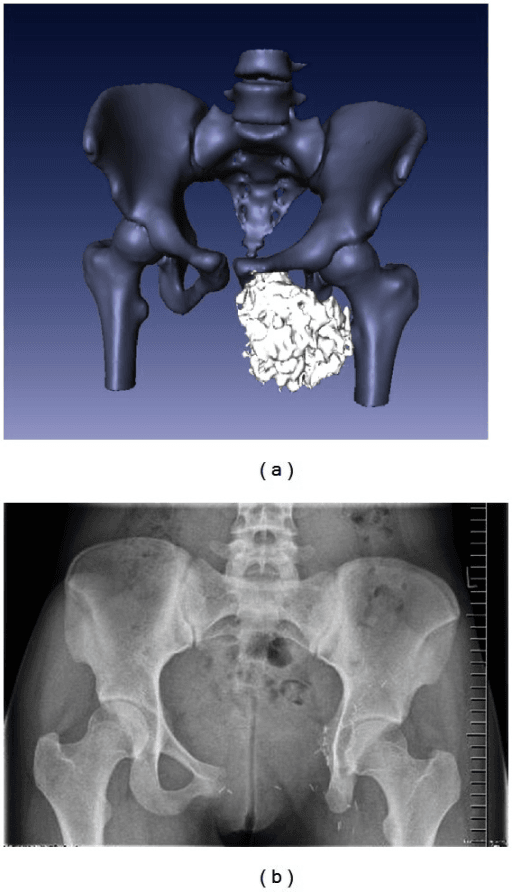 CT reconstruction of pelvis showing pubic and ischial tumour, alongside a radiograph after resection.