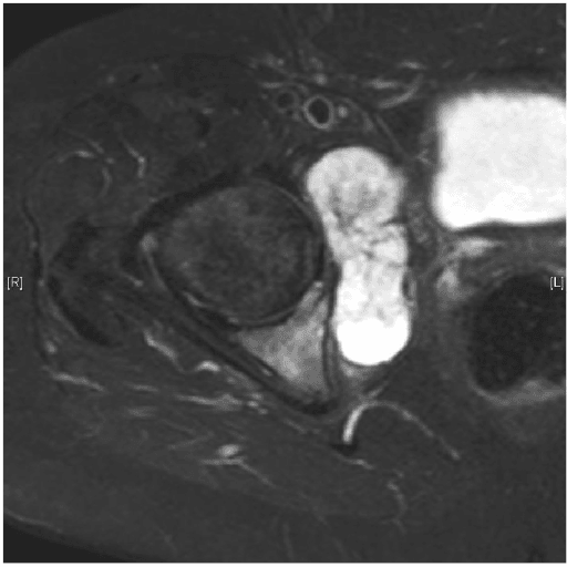Imaging of a periacetabular chondrosarcoma extending beyond bone into surrounding soft tissue.