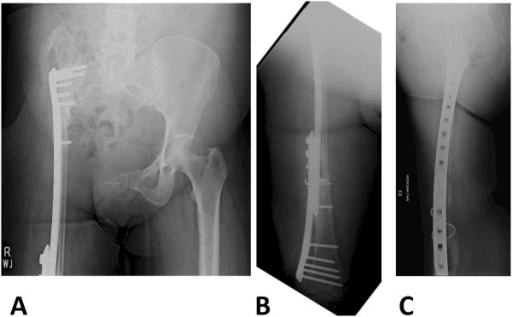 Follow-up radiographs of pelvis and femur one year after pelvic reconstruction.