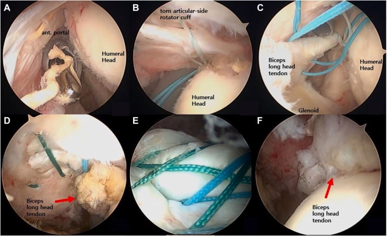 Arthroscopic sequence showing a torn articular-side rotator cuff with the exposed biceps long head tendon used to augment repair without completing the tear
