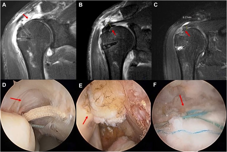 Coronal T2 fat-suppressed MRI of the supraspinatus with tendon thickness measured, alongside arthroscopic views of the articular-sided partial tear