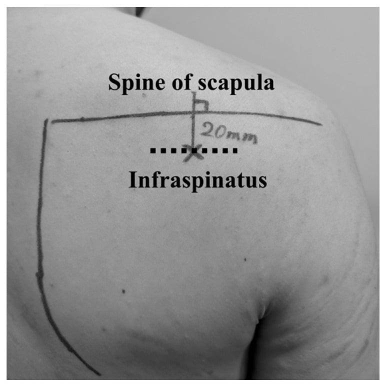 Posterior shoulder with the spine of the scapula marked and the infraspinatus ultrasound measurement point identified 20 mm below it