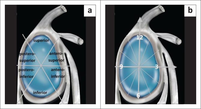 Illustration of labral tear localisation using quadrant description and the clock-face system on the glenoid
