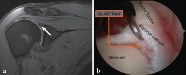 Coronal proton density fat-suppressed MRI showing hyperintense signal extending into the superior labrum with arthroscopy confirming a SLAP tear against the biceps tendon and glenoid