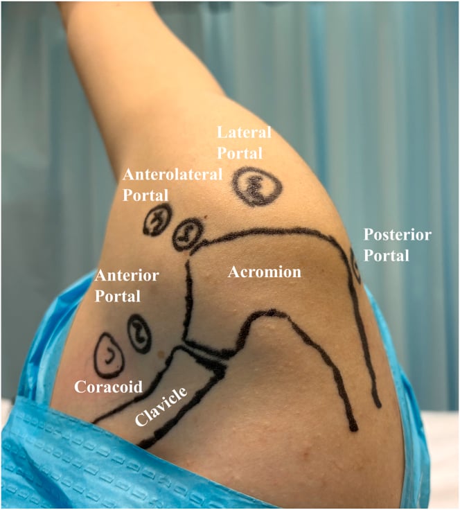 Draped shoulder in lateral decubitus with the acromion, clavicle and coracoid outlined and the posterior, anterior, anterolateral and lateral portals marked