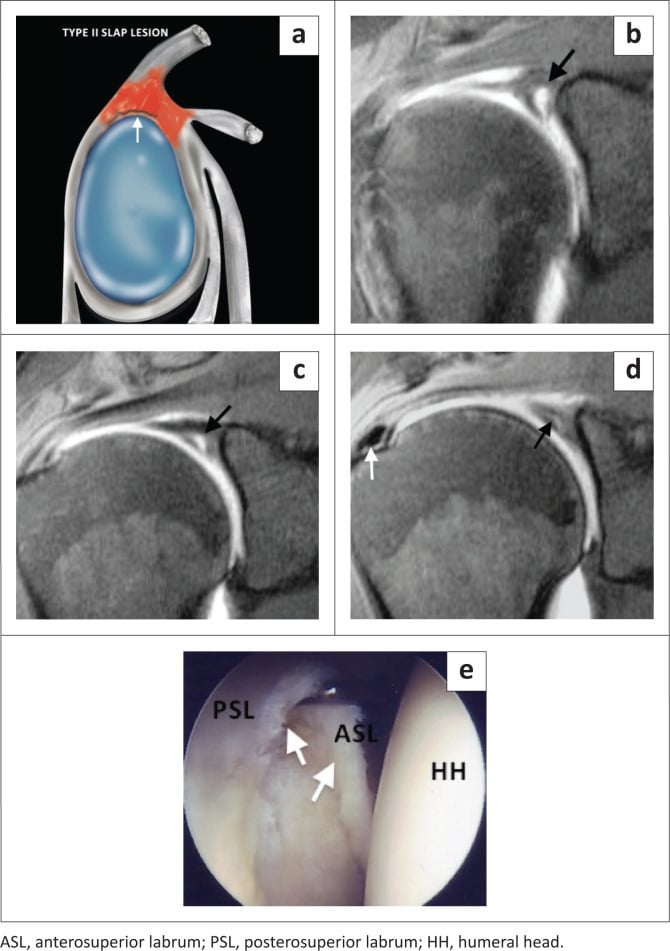 SLAP type II lesion with colour illustration, MR arthrogram showing an enlarged globular sublabral contrast collection, and arthroscopic view of the posterosuperior labrum