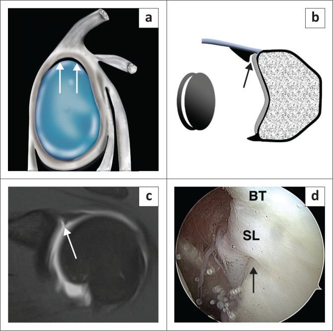 Sublabral recess shown as sagittal and coronal colour illustrations, coronal oblique MR arthrogram and the arthroscopic appearance of the superior labrum