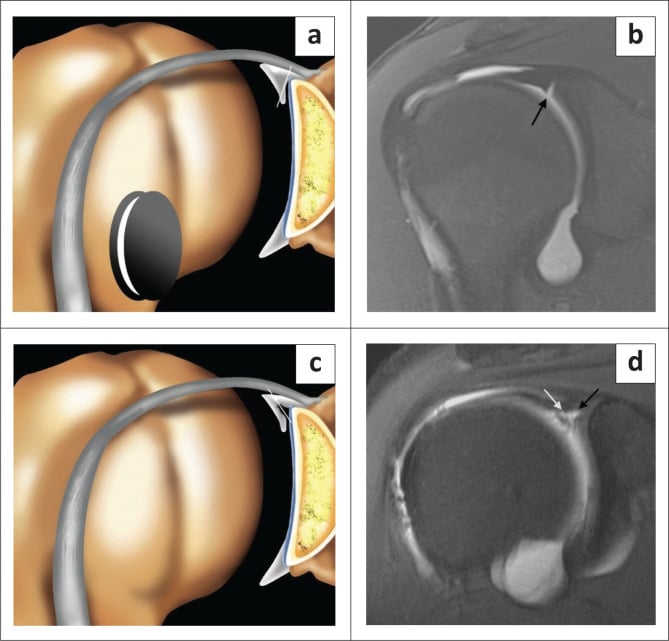 Comparison of a sublabral recess and a SLAP tear with colour illustrations and matching coronal oblique MR arthrograms showing medial versus lateral contrast orientation