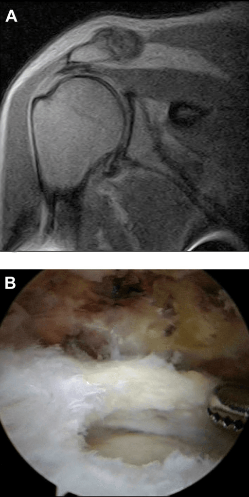 MRI and arthroscopic correlation of rotator cuff and labral pathology