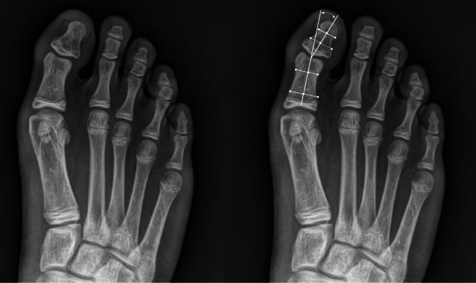 The same forefoot radiograph shown twice, the second copy with lines drawn along the axes of the hallux proximal and distal phalanges