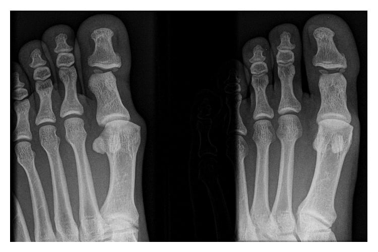 Initial forefoot radiographs, dorsoplantar and oblique, with a subtle hallux interphalangeal dislocation and no true lateral view