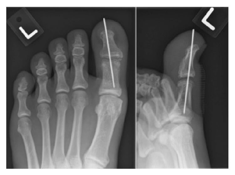 Two-week postoperative hallux radiographs showing a reduced interphalangeal joint held with a single longitudinal K-wire