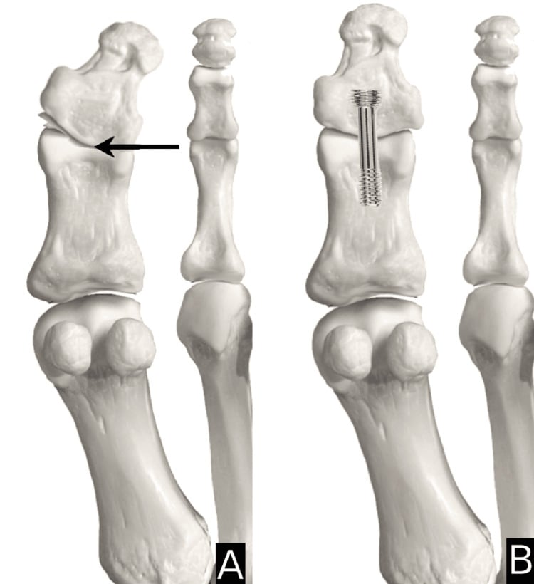Two-panel hallux bone model: A with an arrow at an angulated interphalangeal joint, B with the joint fused by a single longitudinal screw