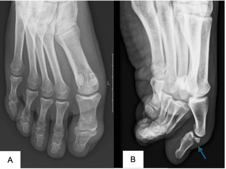Two foot radiographs, panels A and B, with an arrow at the hallux interphalangeal joint marking an intra-articular fracture fragment involving about half of the joint surface and volar subluxation of the joint