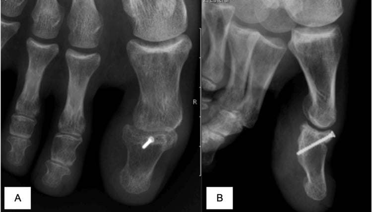 Three-month hallux radiographs, A dorsoplantar and B lateral, after single-screw fixation of an intra-articular distal phalanx fracture