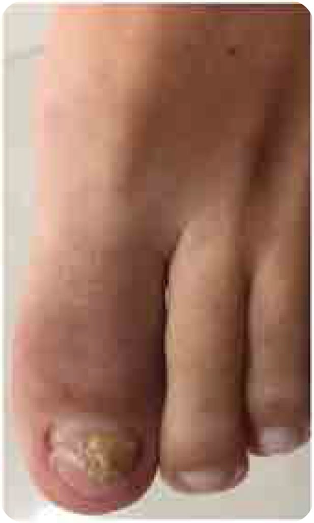 Close-up clinical photograph of a swollen erythematous hallux with nail dystrophy