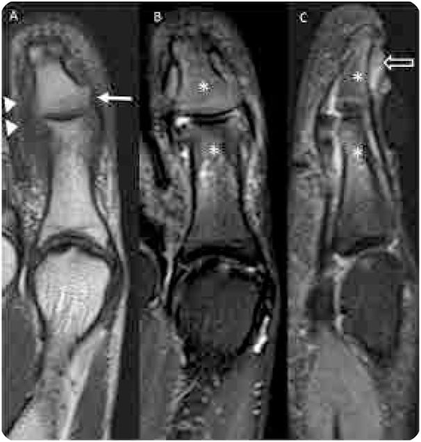 Three hallux MRI panels, A to C, with arrows, arrowheads, asterisks and an open arrow marking erosion, soft-tissue swelling, marrow oedema and nail-bed change