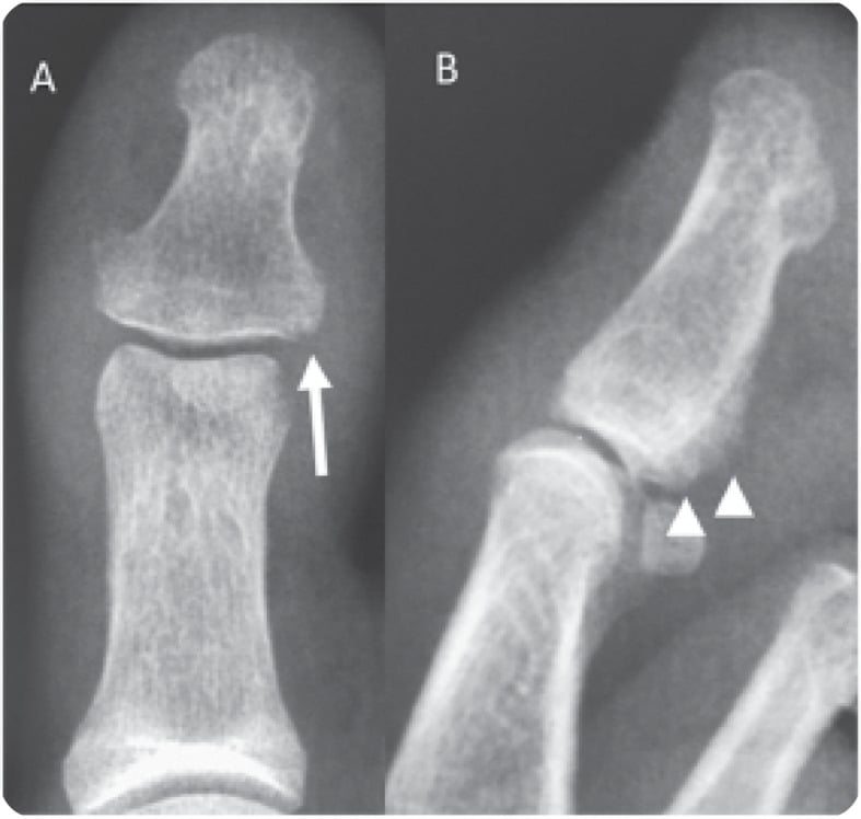 AP (A) and lateral (B) hallux radiographs, with an arrow and arrowheads marking erosion and periosteal reaction