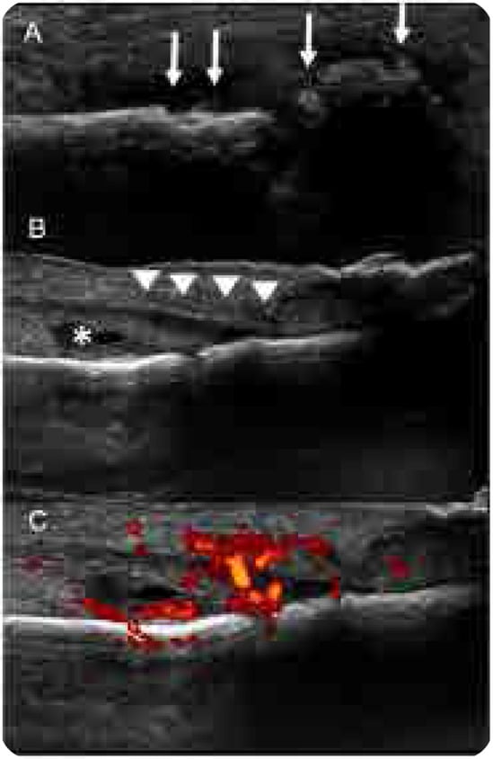 Three hallux ultrasound panels, A to C, with arrows, arrowheads and an asterisk, the last panel showing Doppler signal