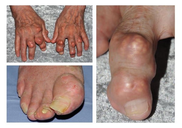 Three clinical photographs of tophaceous gout: nodular swellings over the finger joints of both hands, and two views of a great toe with nodular swelling and yellow-white deposits