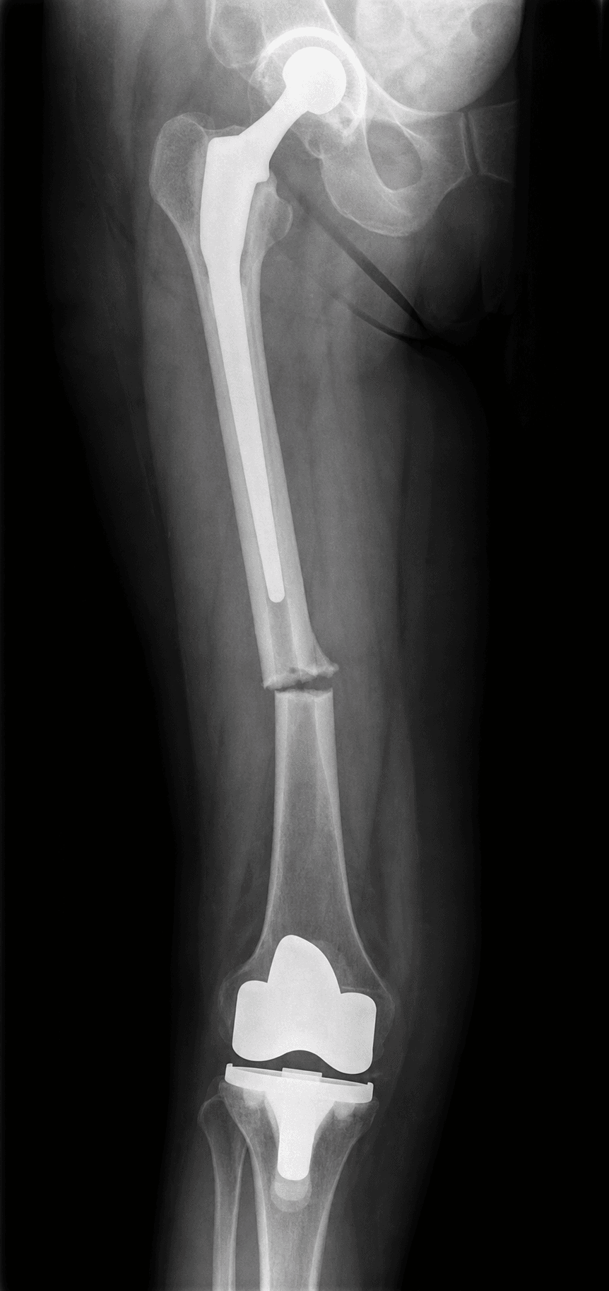 AP femur radiograph showing a femoral shaft fracture between a hip stem and a knee replacement