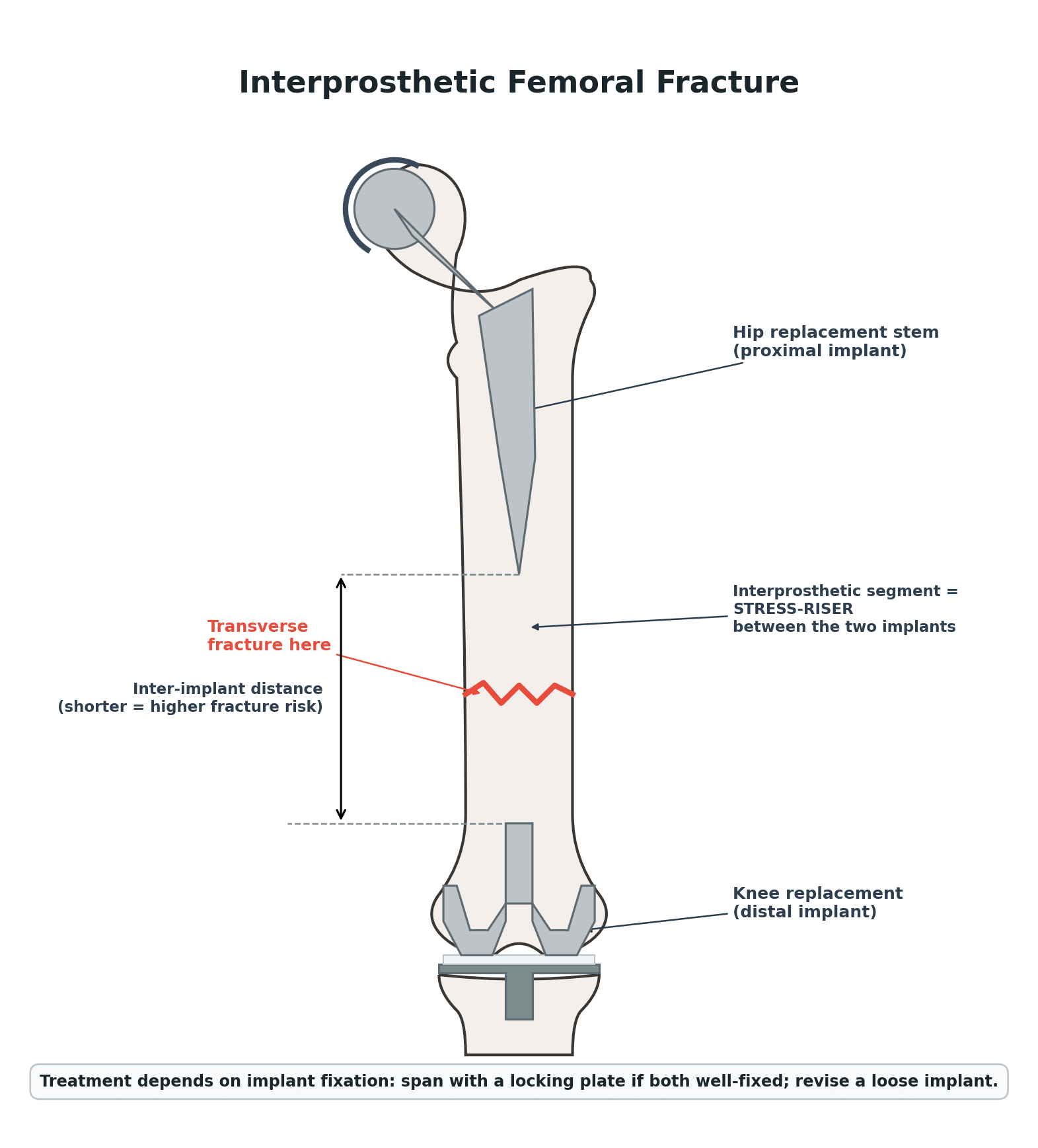 Diagram of an interprosthetic femoral fracture: a transverse femoral shaft fracture in the segment of bone trapped between a hip replacement stem proximally and a knee replacement distally