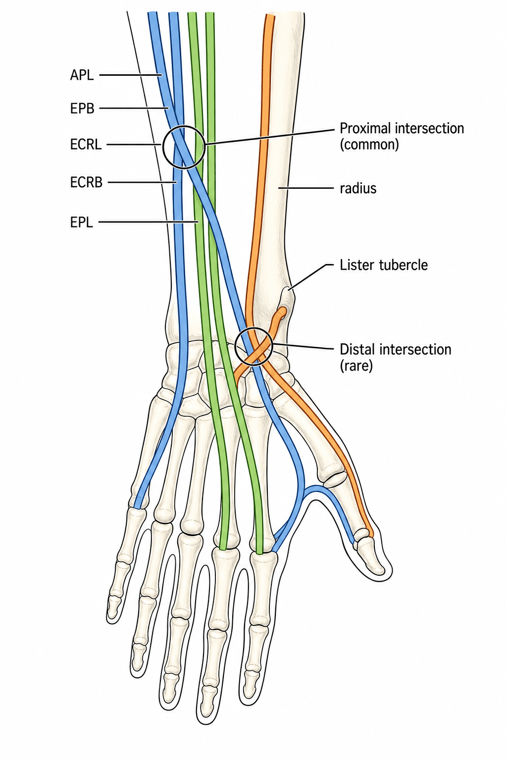 Schematic of the dorsal wrist extensor compartments showing the proximal intersection (1st compartment over 2nd) and distal intersection (3rd compartment/EPL over 2nd, at Lister tubercle)