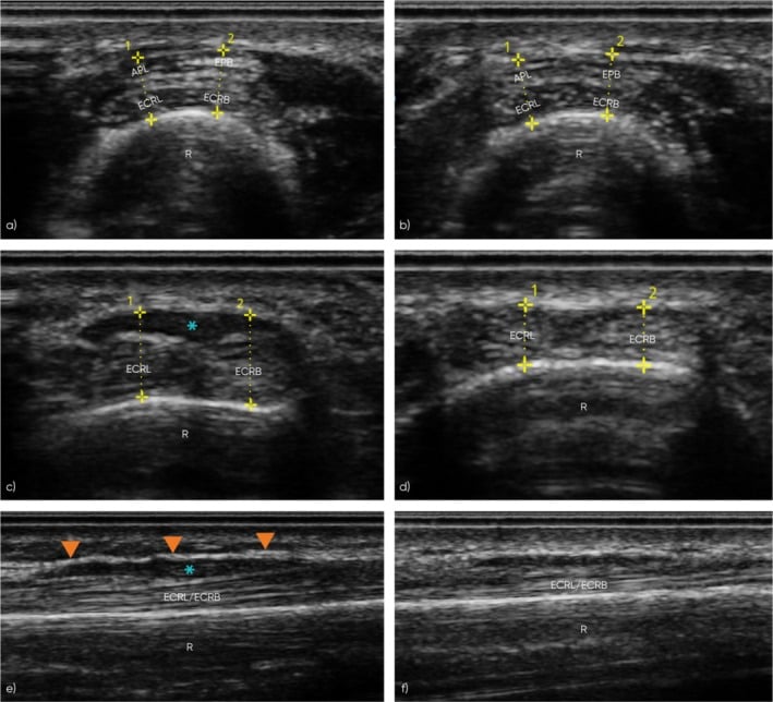 Comparative ultrasound of symptomatic and asymptomatic proximal intersections